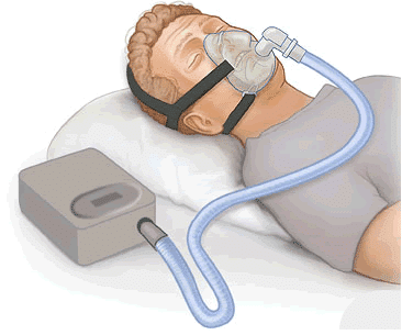 CPAP治疗(持续气道正压)是什么?